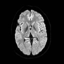 File:Neuro-Behcet's disease (Radiopaedia 21557-21506 Axial DWI 14).jpg