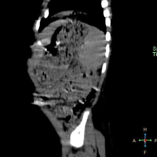 File:Neuroblastoma (Radiopaedia 24751-25016 C 3).jpg