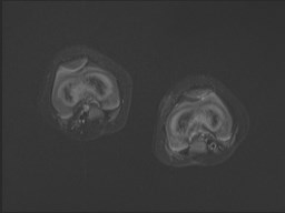 File:Neuroblastoma with bone metastases (Radiopaedia 67080-76414 Axial STIR 7).jpg