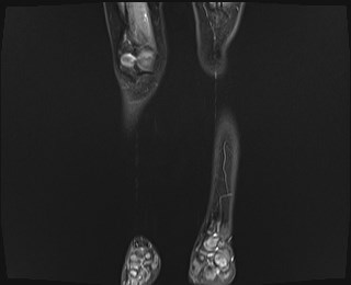 File:Neuroblastoma with bone metastases (Radiopaedia 67080-76414 B 2).jpg