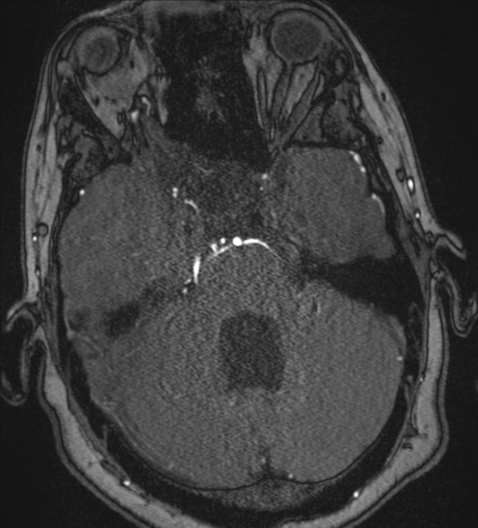 Neurofibromatosis type 1 - head and neck - CNS manifestations (Radiopaedia 49910-55188 Axial MRA 23).png