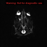 File:Neurofibromatosis type 1 with optic nerve glioma (Radiopaedia 16288-15965 Axial DWI 21).jpg