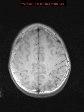 File:Neurofibromatosis type 1 with optic nerve glioma (Radiopaedia 16288-15965 Axial T1 6).jpg