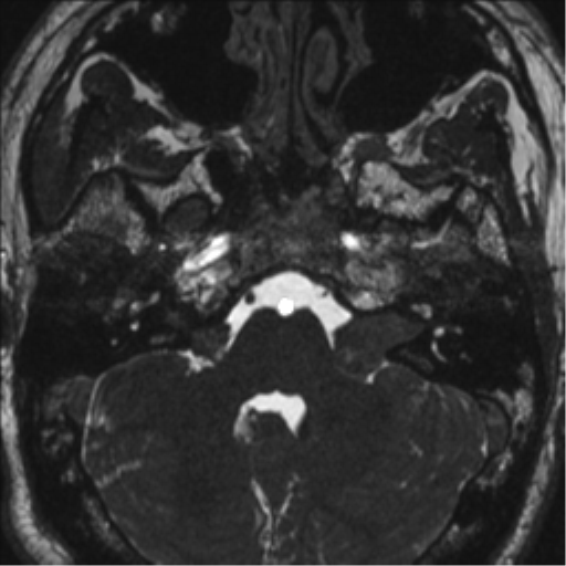 Neurofibromatosis type 2 (Radiopaedia 44936-48838 E 25).png