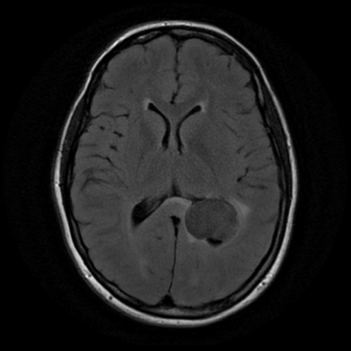 File:Neurofibromatosis type 2 (Radiopaedia 45229-49244 Axial FLAIR 11).png