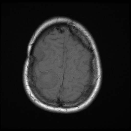 File:Neurofibromatosis type 2 (Radiopaedia 45229-49247 Axial T1 19).png