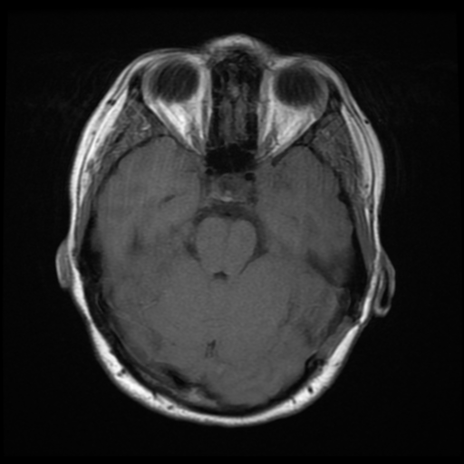 File:Neurofibromatosis type 2 (Radiopaedia 45229-49247 Axial T1 8).png