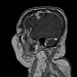 File:Neurofibromatosis type 2 (Radiopaedia 8713-9518 Sagittal T1 C+ 10).jpg