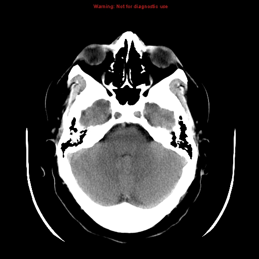 File:Neuroglial cyst (Radiopaedia 10713-11185 Axial non-contrast 24).jpg