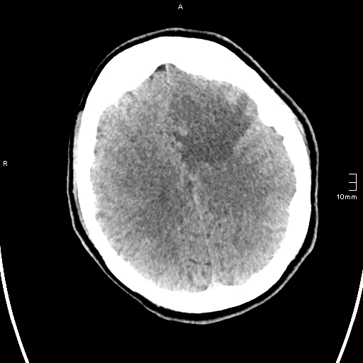 File:Neurotoxoplasmosis - concentric target sign (Radiopaedia 70644-80783 Axial non-contrast 26).jpg
