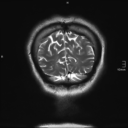 File:Neurotoxoplasmosis - concentric target sign (Radiopaedia 70644-80784 Coronal T2 9).jpg