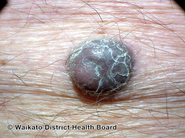File:Nodular melanoma (DermNet NZ melanoma-abcds-23).jpg