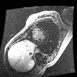 File:Non-compaction of the left ventricle (Radiopaedia 38868-41062 E 7).jpg