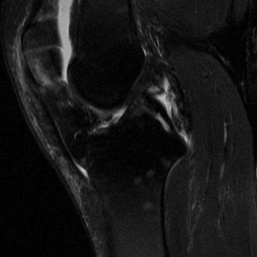 File:Non-displaced patella fracture (Radiopaedia 15932-15582 Sagittal T2 fat sat 8).jpg