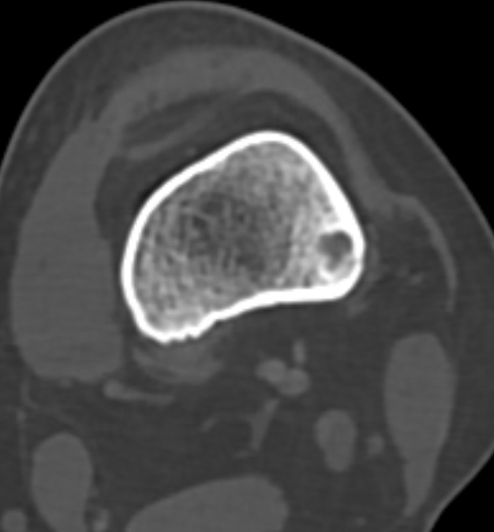 Non-ossifying fibroma - femur (Radiopaedia 82786-97042 Axial bone window 45).jpg