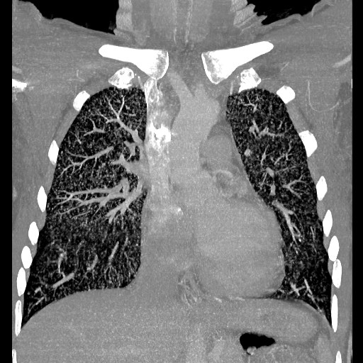 File:Non-small cell lung cancer with miliary metastases (Radiopaedia 23995-24193 Coronal lung window 6).jpg