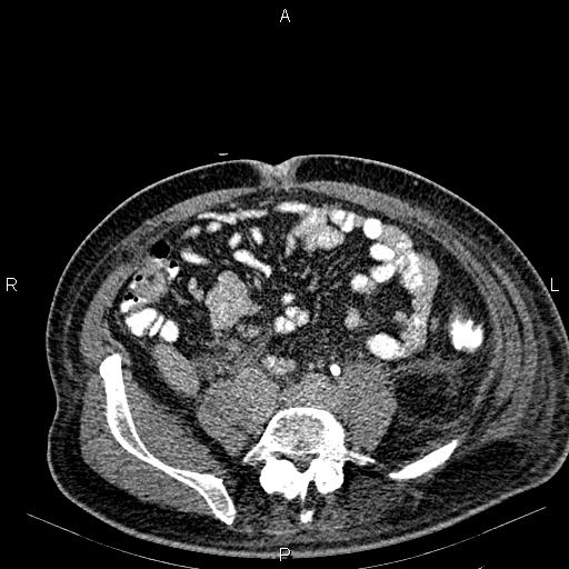 Non Hodgkin lymphoma in a patient with ankylosing spondylitis (Radiopaedia 84323-99621 Axial C+ delayed 51).jpg