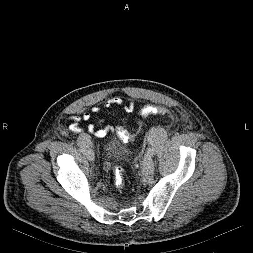 Non Hodgkin lymphoma in a patient with ankylosing spondylitis (Radiopaedia 84323-99621 Axial C+ delayed 67).jpg