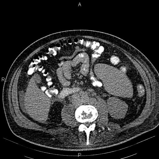 File:Non Hodgkin lymphoma in a patient with ankylosing spondylitis (Radiopaedia 84323-99621 Axial non-contrast 40).jpg