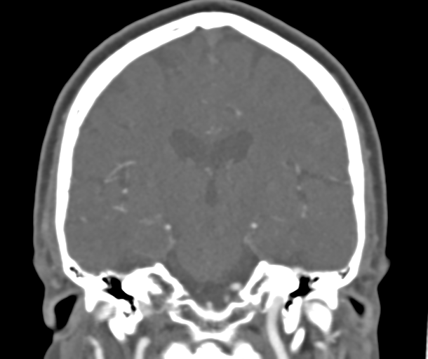 File:Normal CTA head (Radiopaedia 40801-43464 B 55).png