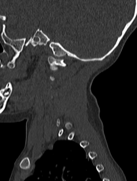 Normal CT cervical spine - pediatric (Radiopaedia 52549-58462 Sagittal bone window 195).jpg