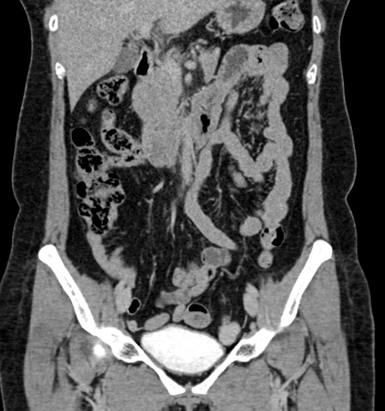 Normal CT intravenous urogram (Radiopaedia 39444-41759 A 242).jpg