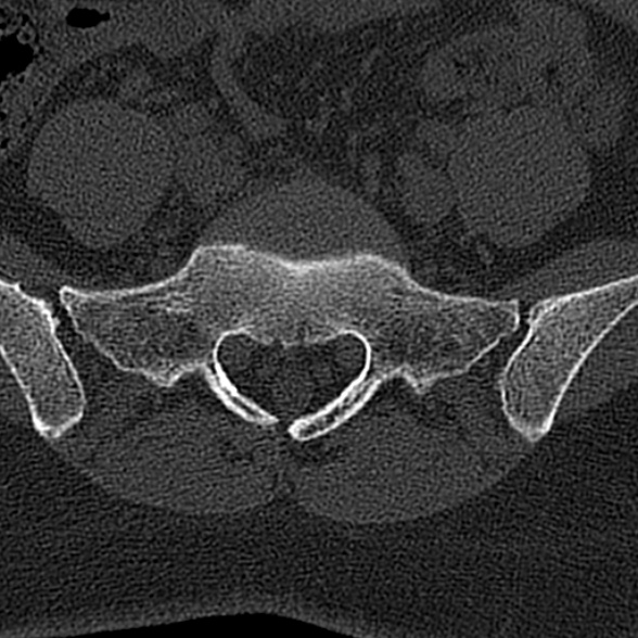 File:Normal CT lumbar spine (Radiopaedia 53981-60118 Axial bone window 66).jpg