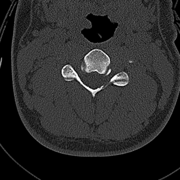 File:Normal CT of the cervical spine (Radiopaedia 53322-59305 Axial bone window 119).jpg