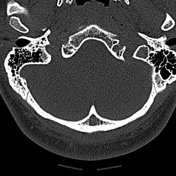 File:Normal CT of the cervical spine (Radiopaedia 53322-59305 Axial bone window 25).jpg