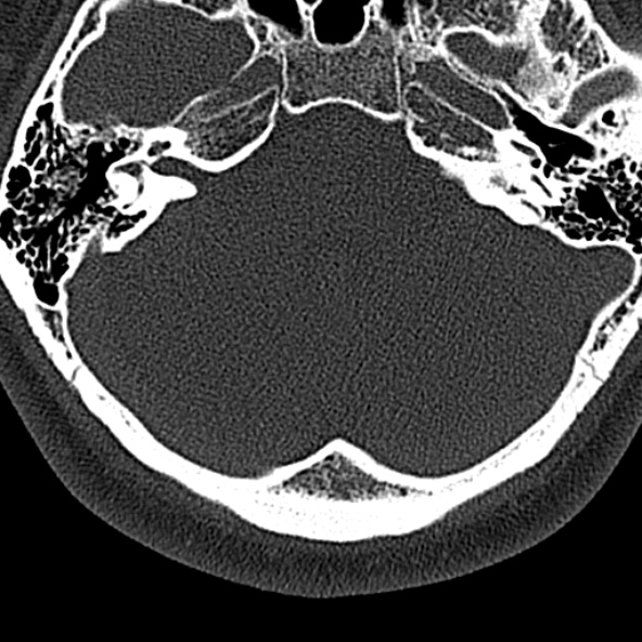 Normal CT of the cervical spine (Radiopaedia 53322-59305 Axial bone window 6).jpg
