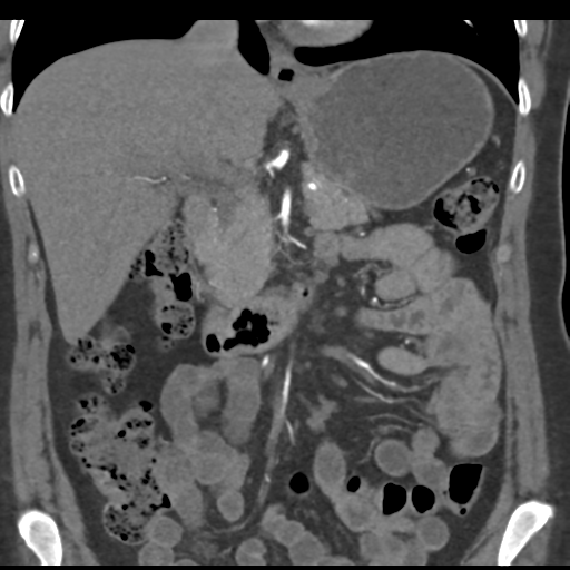 File:Normal CT renal artery angiogram (Radiopaedia 38727-40889 B 34).png