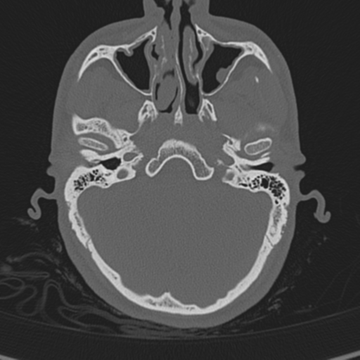 Normal CT skull (Radiopaedia 40798-43459 A 34).png