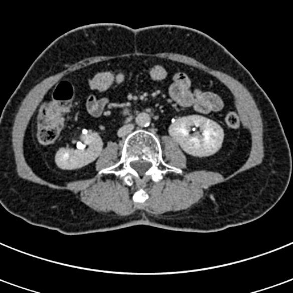 File:Normal CT split bolus study of the renal tract (Radiopaedia 48631-53634 Axial split bolus 127).jpg