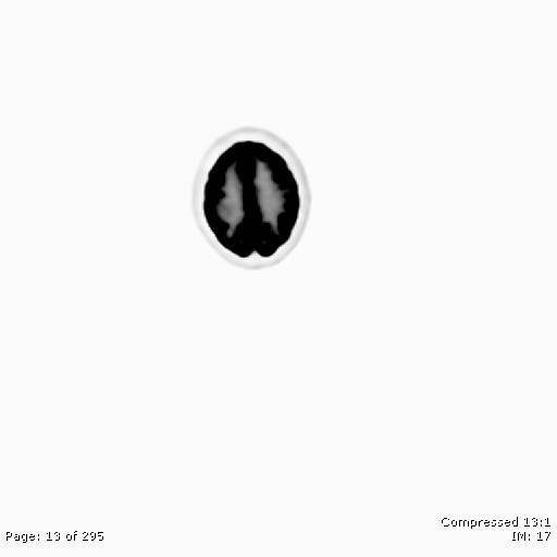 File:Normal F-18 FDG PET-CT (Radiopaedia 77382-89510 C 13).jpg