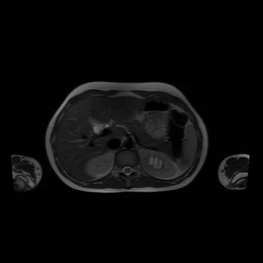 File:Normal MRI abdomen in pregnancy (Radiopaedia 88001-104541 Axial T2 14).jpg