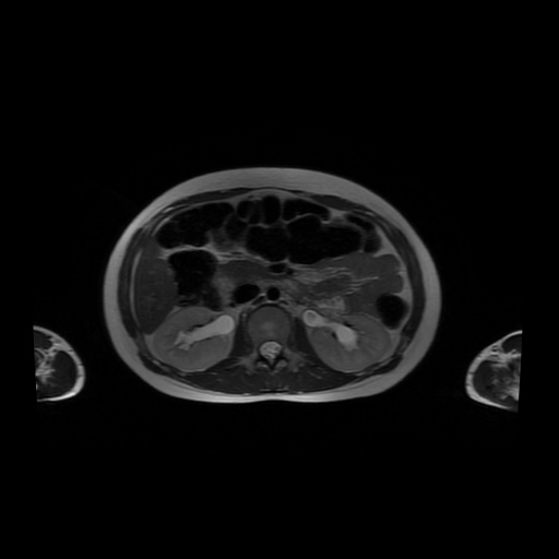 File:Normal MRI abdomen in pregnancy (Radiopaedia 88001-104541 Axial T2 24).jpg