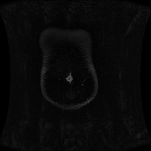 Normal MRI abdomen in pregnancy (Radiopaedia 88001-104541 M 17).jpg