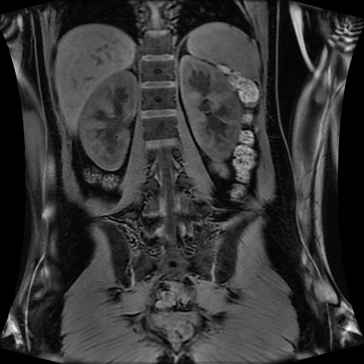 Normal MRI abdomen in pregnancy (Radiopaedia 88001-104541 M 99).jpg