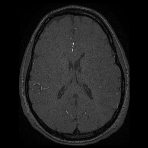 Normal brain MRA (Radiopaedia 41046-43793 Axial MRA 2).png