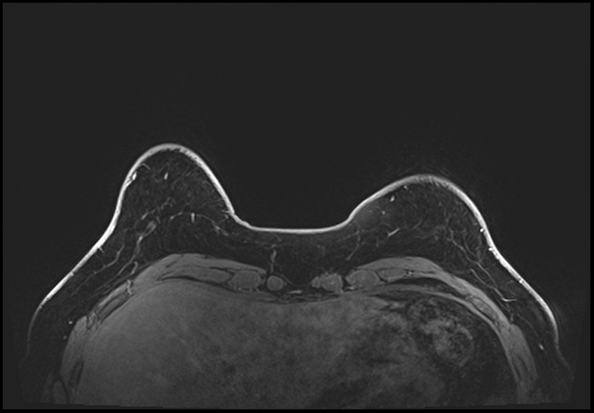 Normal breast MRI - dense breasts (Radiopaedia 80454-93850 C 35).jpg