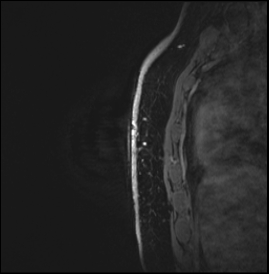 Normal breast MRI - dense breasts (Radiopaedia 80454-93850 I 155).jpg