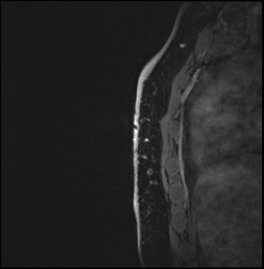 Normal breast MRI - dense breasts (Radiopaedia 80454-93850 I 160).jpg
