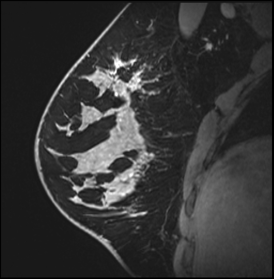 Normal breast MRI - dense breasts (Radiopaedia 80454-93850 I 67).jpg