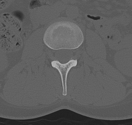 File:Normal lumbar spine CT (Radiopaedia 46533-50986 Axial bone window 27).png