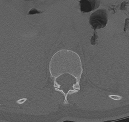 File:Normal lumbosacral CT (Radiopaedia 37923-39867 Axial bone window 18).png