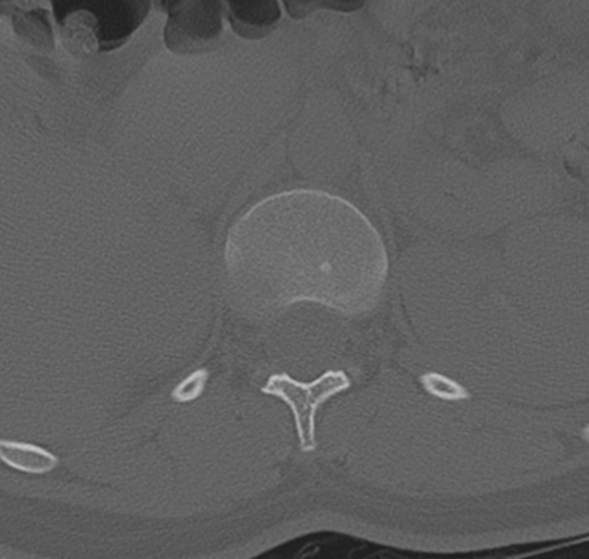 File:Normal lumbosacral CT (Radiopaedia 37923-39867 Axial bone window 26).png