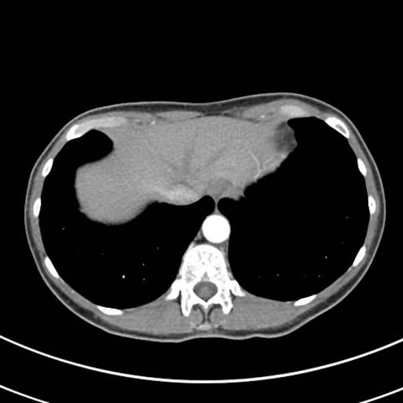 File:Normal multiphase CT liver (Radiopaedia 38026-39996 B 8).jpg