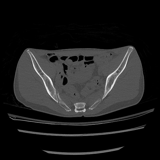 Normal pelvis CT (Radiopaedia 51471-57236 Axial bone window 45).jpg