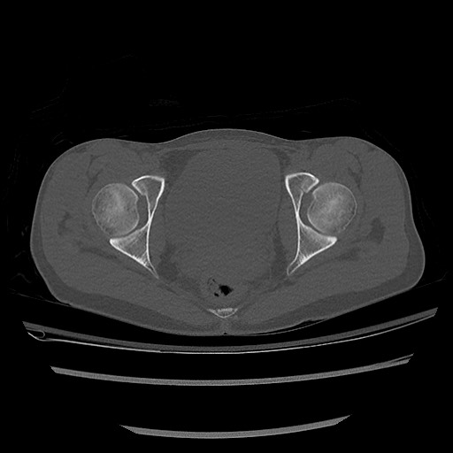 Normal pelvis CT (Radiopaedia 51471-57236 Axial bone window 72).jpg