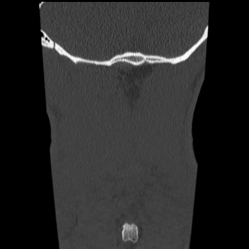 File:Normal trauma cervical spine (Radiopaedia 41017-43760 Coronal bone window 48).png